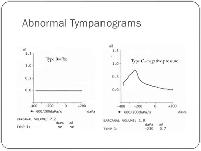 timpanogram - ispitivanje srednjeg uva