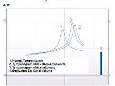TET - Test Eustahijeve tube